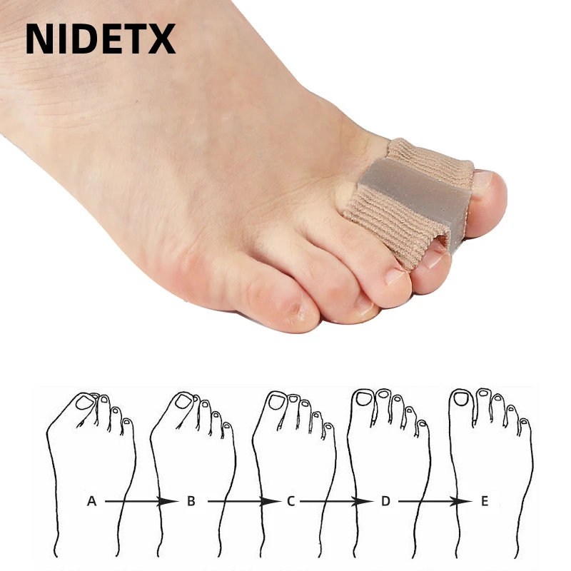 1pcs Silikónový špičkový prsty odlučovač prstov Bunon Hallux Valgus korektor korekcie palca korekcia Priadok Ortopedic ortopedic