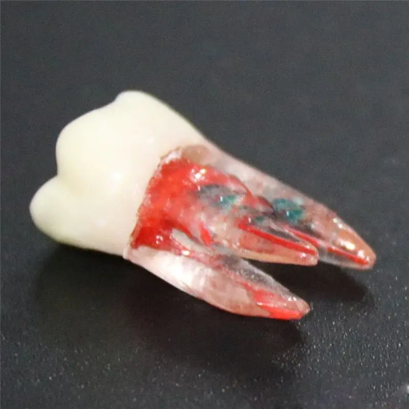 1pcs zubná chirurgia živici Endodontic Practice Model s modelom farebného modelu koreňového kanála