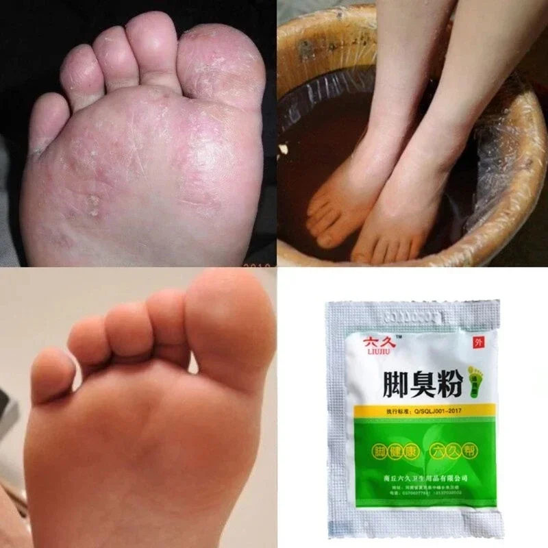 20/10BAG dezodorantné nohy práškového prášku Decodorant Foot Foot Antipruritic Foot Have Foots Pows Foots Práškovú obuv Deodorant