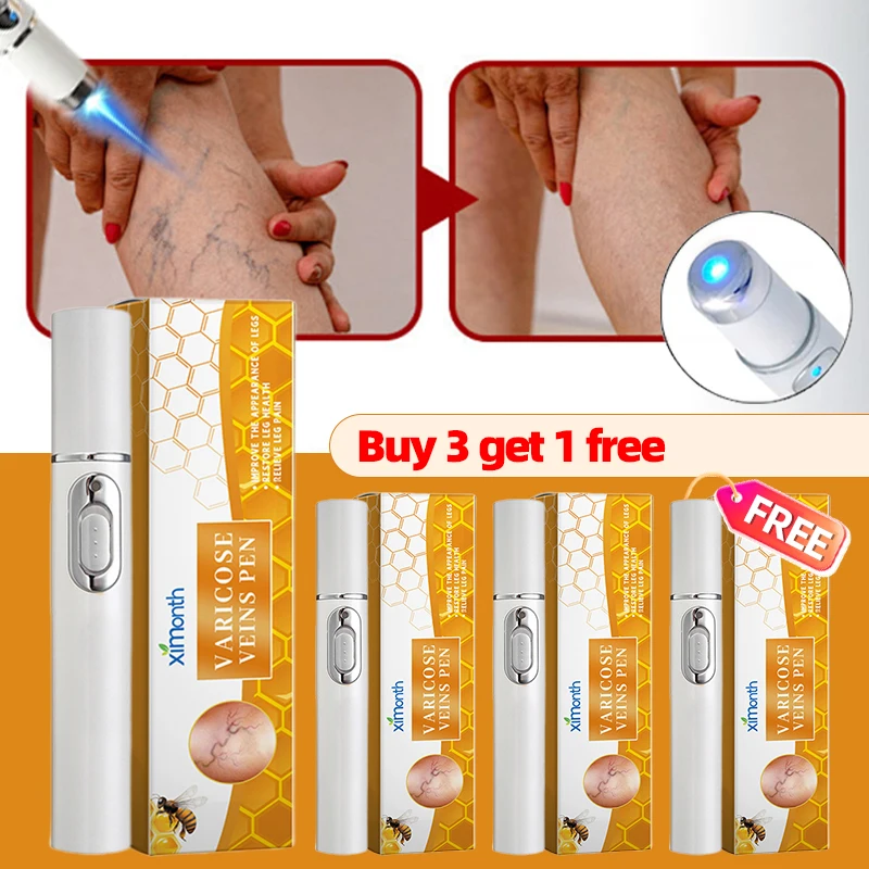 4pcs Oprava nôh laserové pero vaskulitída Phlebitis Demontáž Vaskulitída Zlepšenie krvného obehu kŕč