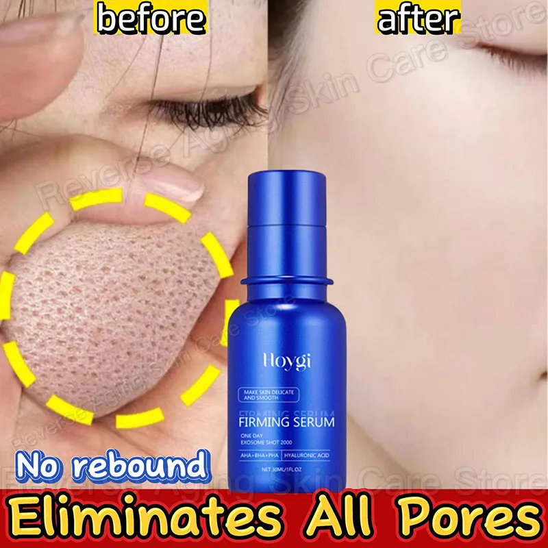 Blue Microneedle Zmršťovanie pórov tvár
