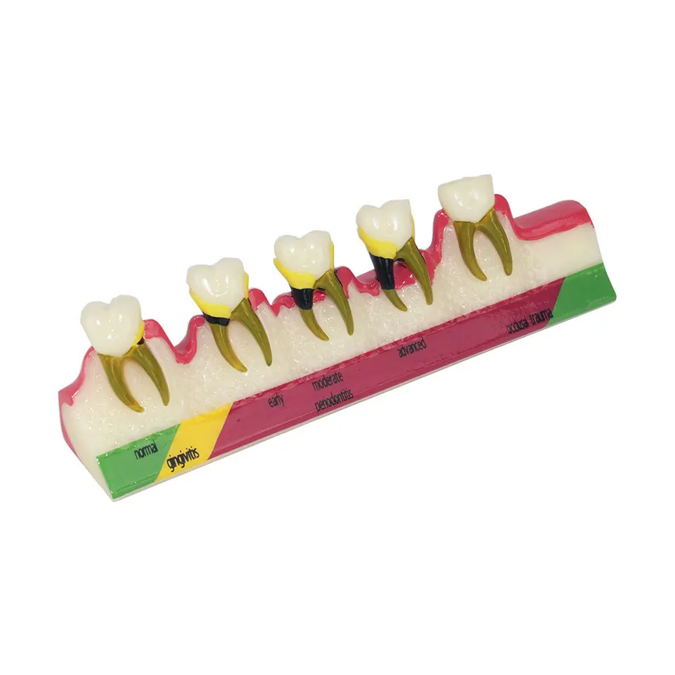 Model klasifikácie periodontálneho ochorenia Model gingivitídy Chronická periodontitída zubná komunikácia Perorálny zubný model