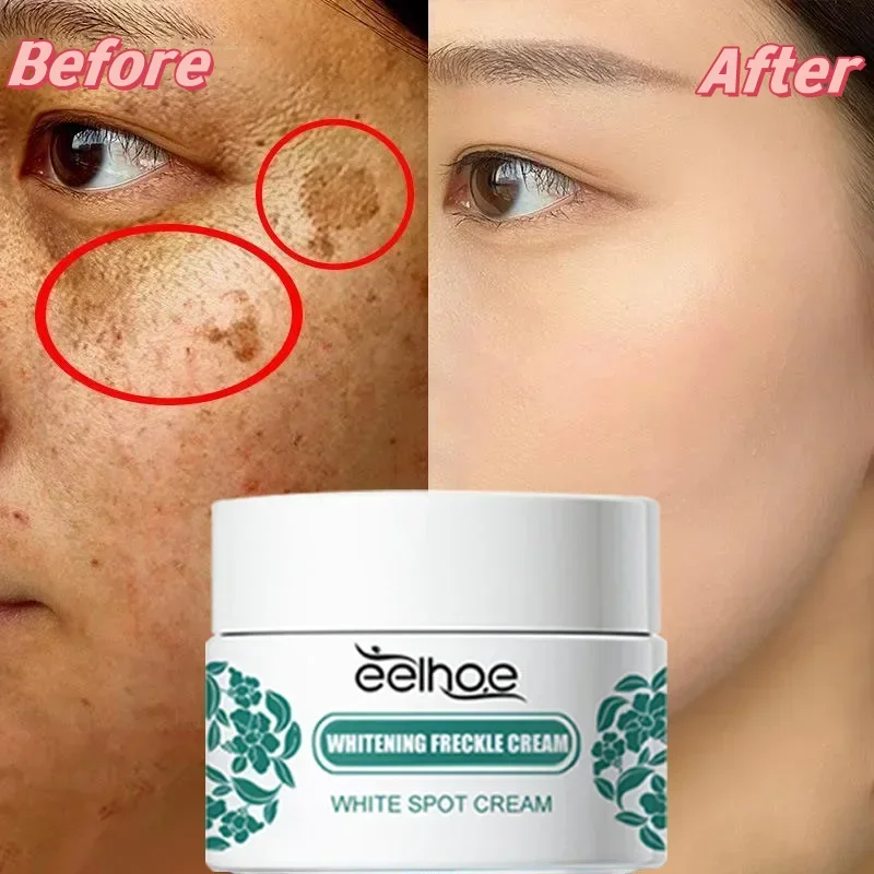 Niacinamid melasma rozjasnenie krém Zosvetľuje tmavú pokožku Chloasma sérum Zmiznuté jemné čelné línie reduku