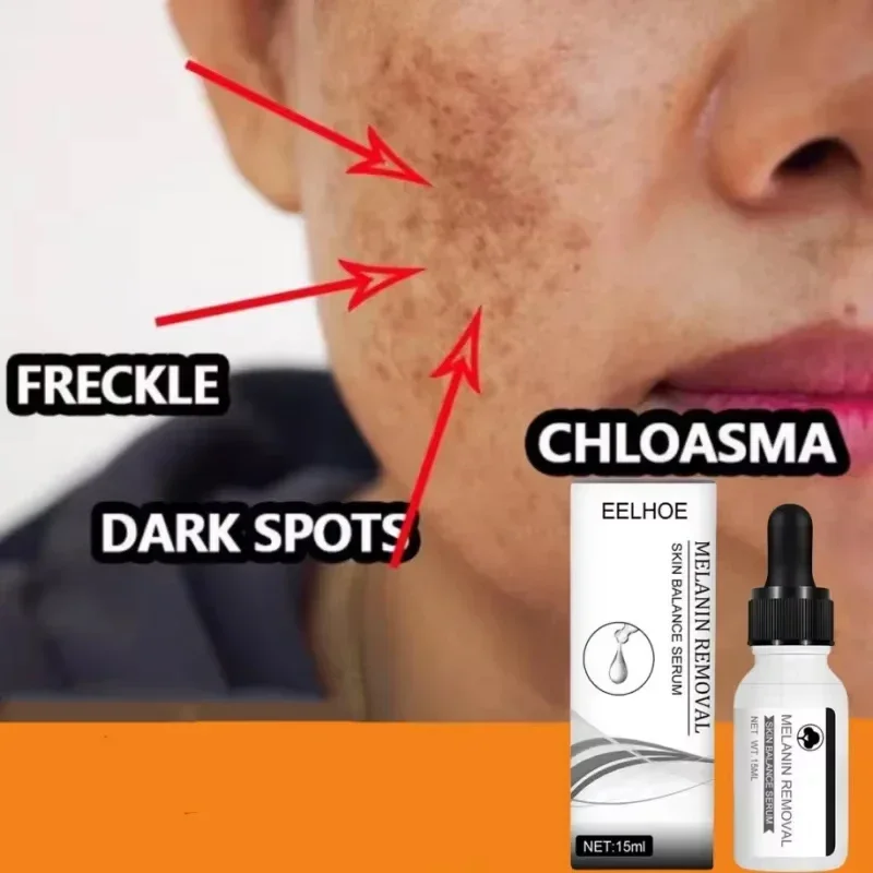 Niacinamid tmavé škvrny remover sérum pehla biela vlhkosť Demontáž čierna bodka melasma chloasma tvár starostlivosti o pleť