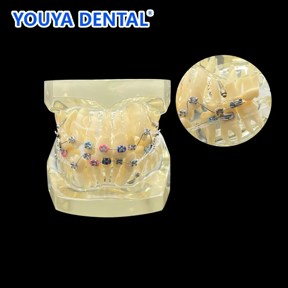 Ortho kovový držiak Model ortodontické ošetrenie zuby Model Štandardná malocclusion demo s kovovými držiakmi lekár-pacient