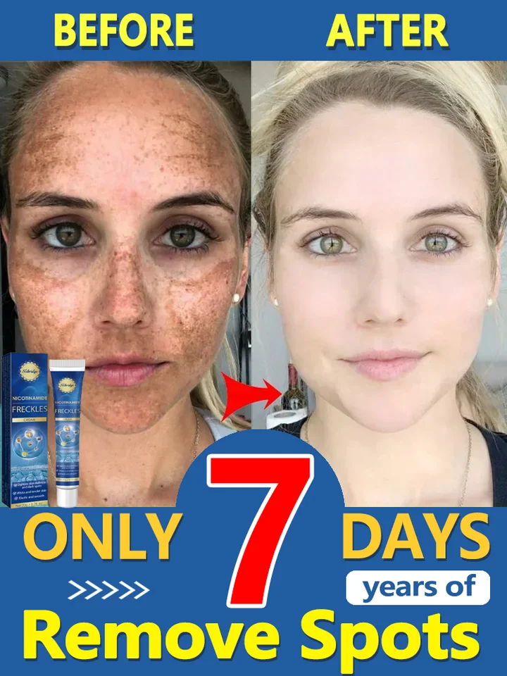 Peha bieliaci krém na odstránenie tmavých škvŕn melasma