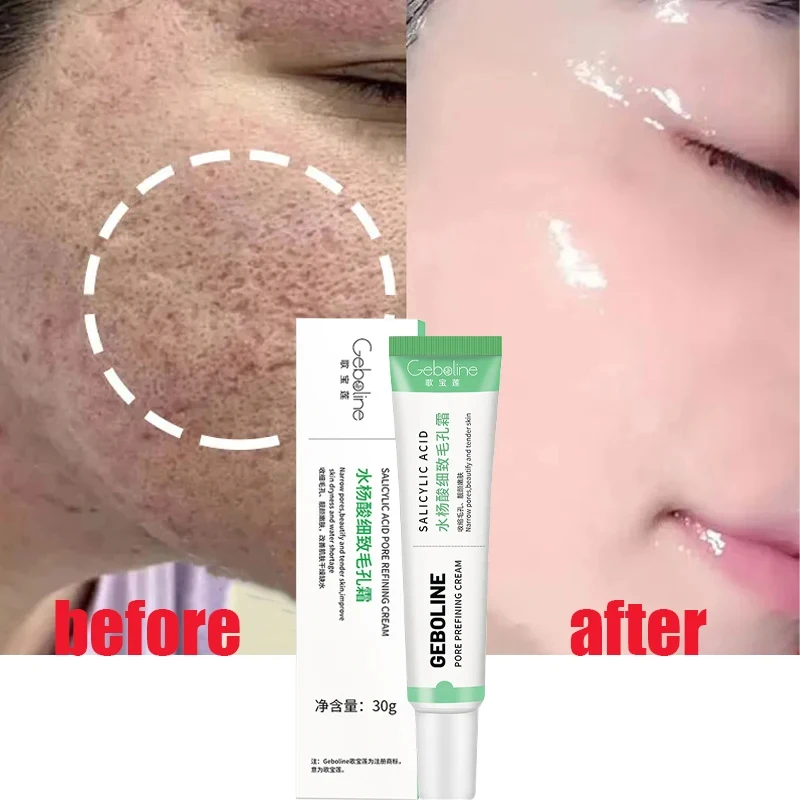 Slalicylová kyselina póry Zmenenie krému Rýchle eliminácia Veľké póry Odstráňte blackehead utiahnite úhľadnú pokožku Koža Korean Care Produkt