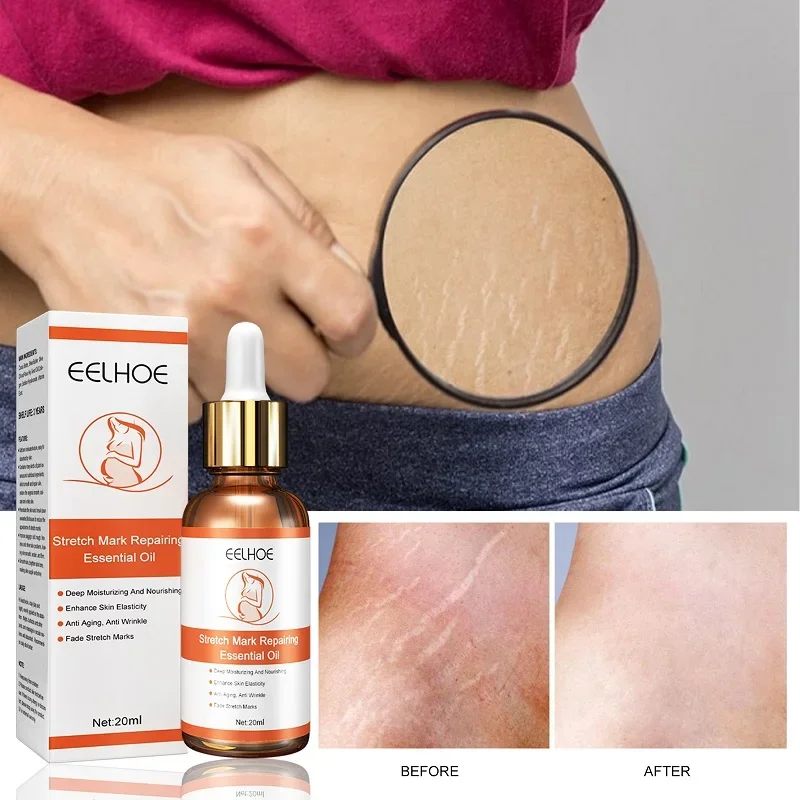 Stretch Marks Oprava éterického oleja starostlivosť o pokožku Ošetrenie krémom na odstraňovač materstva proti vráskam slackline pre tehotné oleje 20 ml