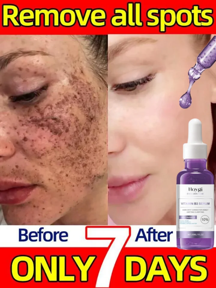Tmavé škvrny Remover bieliaci sérum tvár Freckle Melanín Koritácia anti pigmentácie rozjasnite krásu Krása Kórejská denná noc starostlivosť o pleť