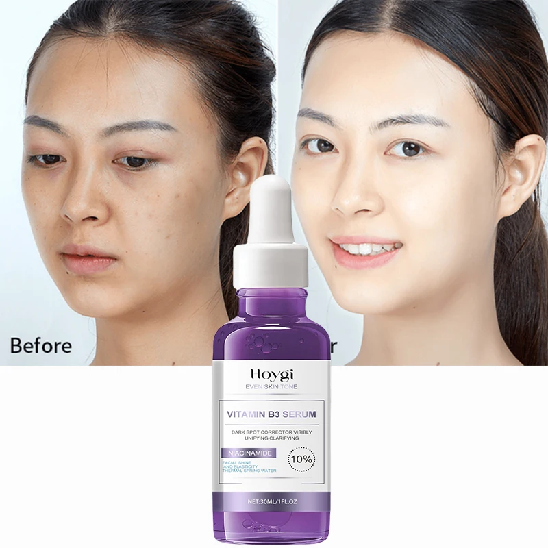 Vitamín B3 v sére proti starnutiu Niacinamid bieliace melasma akné pehy Dark Spot Remover