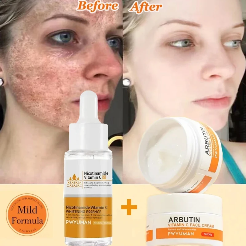 Vitamín C bieliace pehy sérové ​​krém odstraňujú tmavé škvrny melasma niacinamid odľahčenie melanínových jaziev akné proti starnutiu starostlivosť