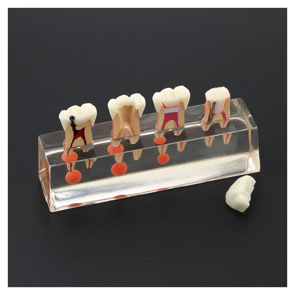Zubné zuby Model M4018 Endodontická liečba 4-stupňový molárny koreňový kanál zubný kaz na štúdium výučby